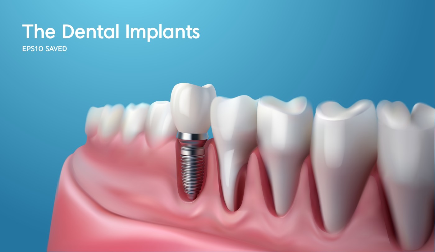 implant dentar în Brăila