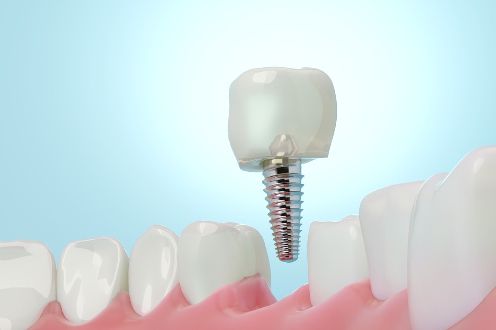 implant dentar Brăila