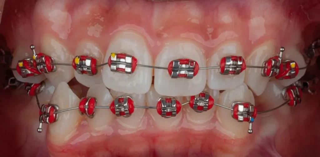 9 Semne Că Ai Putea Avea Nevoie De Aparat Dentar1