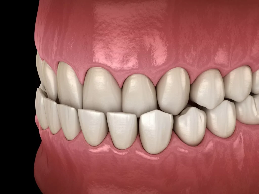 9 Semne Că Ai Putea Avea Nevoie De Aparat Dentar4