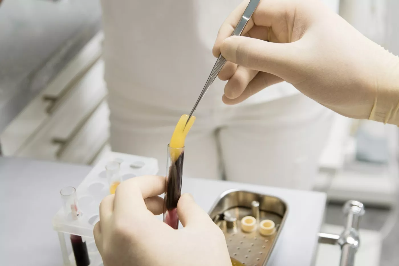 A PRF – Stomatologie Avansată în Brăila