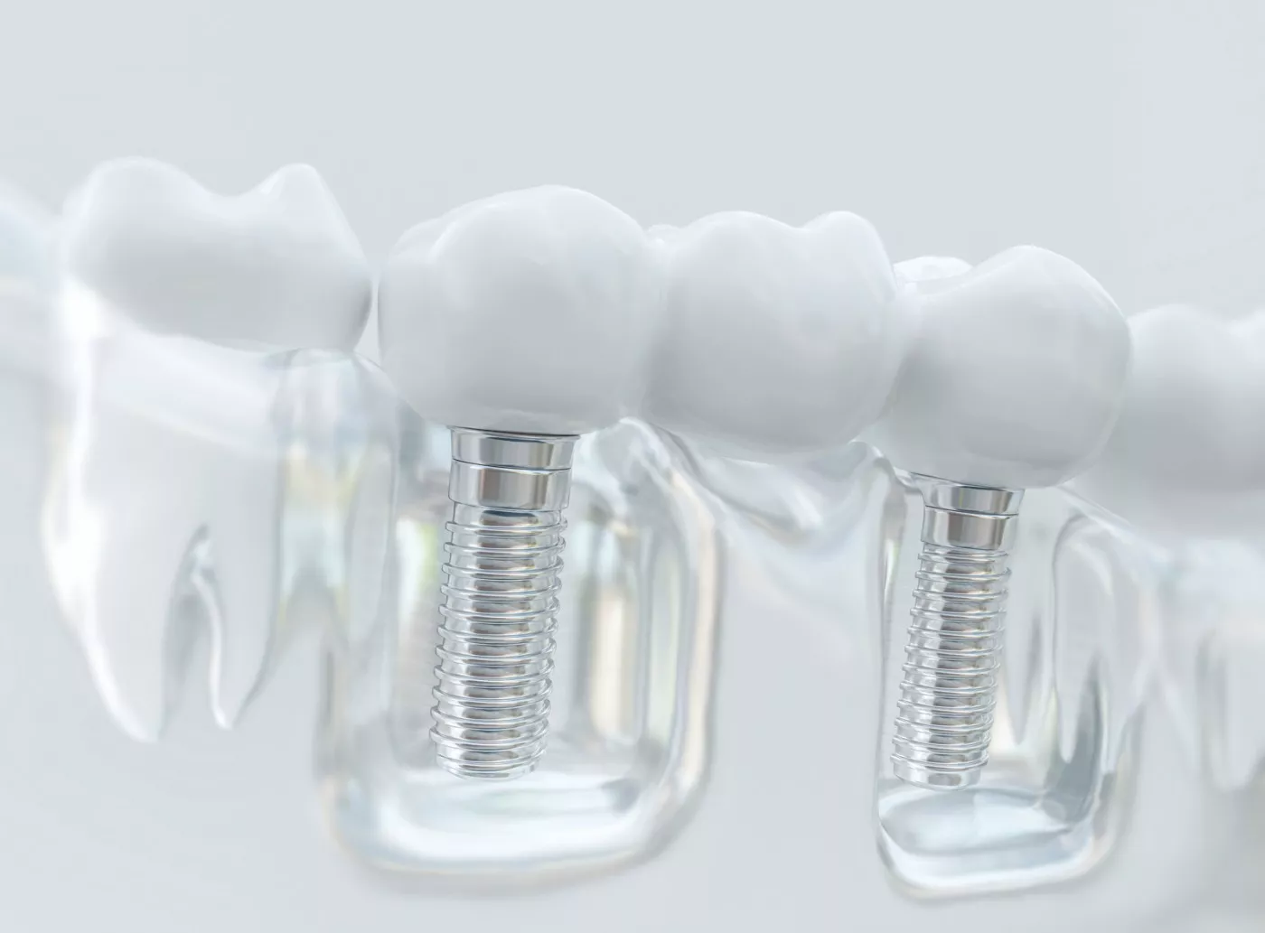 Implant Dentar Brăila