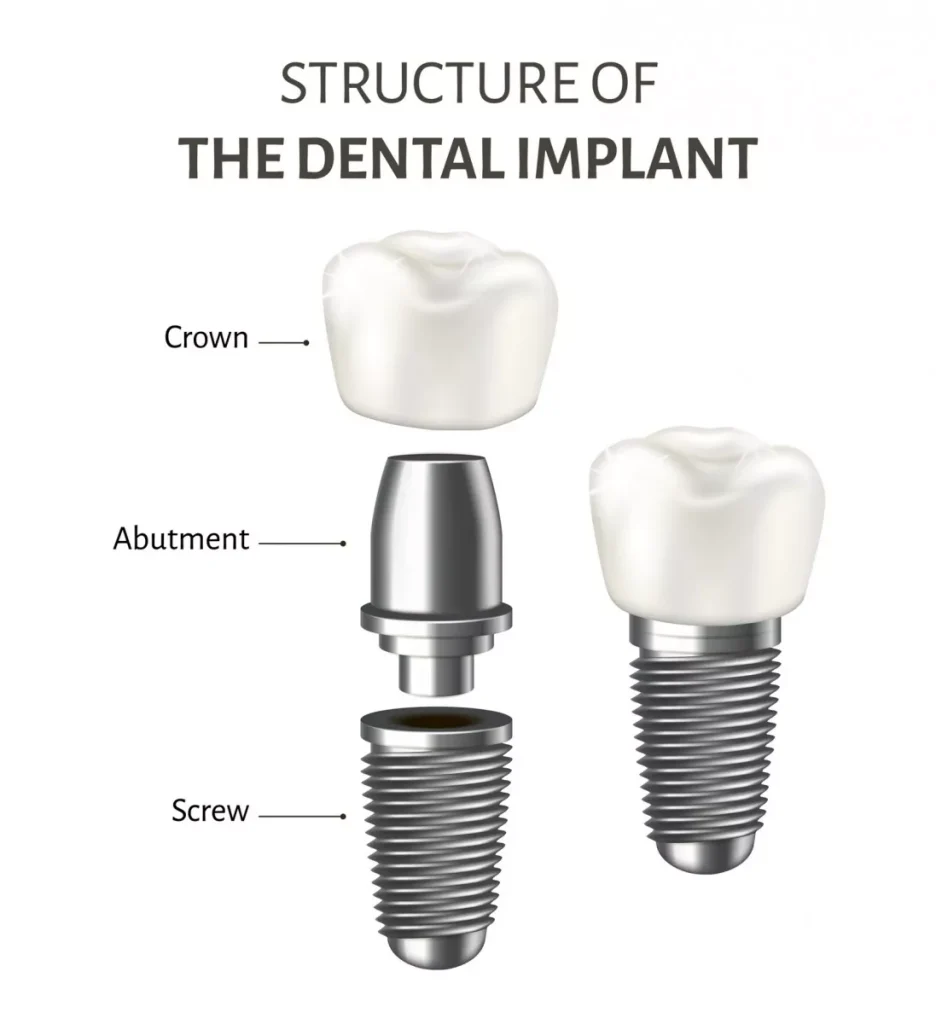 Implant Dentar Brăila1