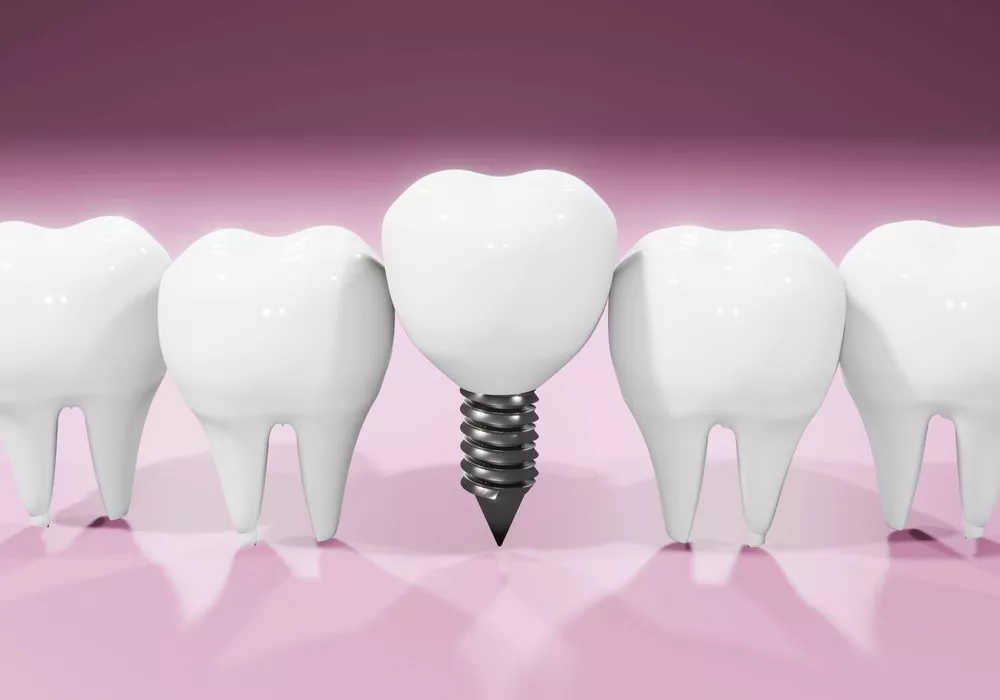 Implant Dentar Sau Punte Dentară Ce Ar Trebui Să Aleg2