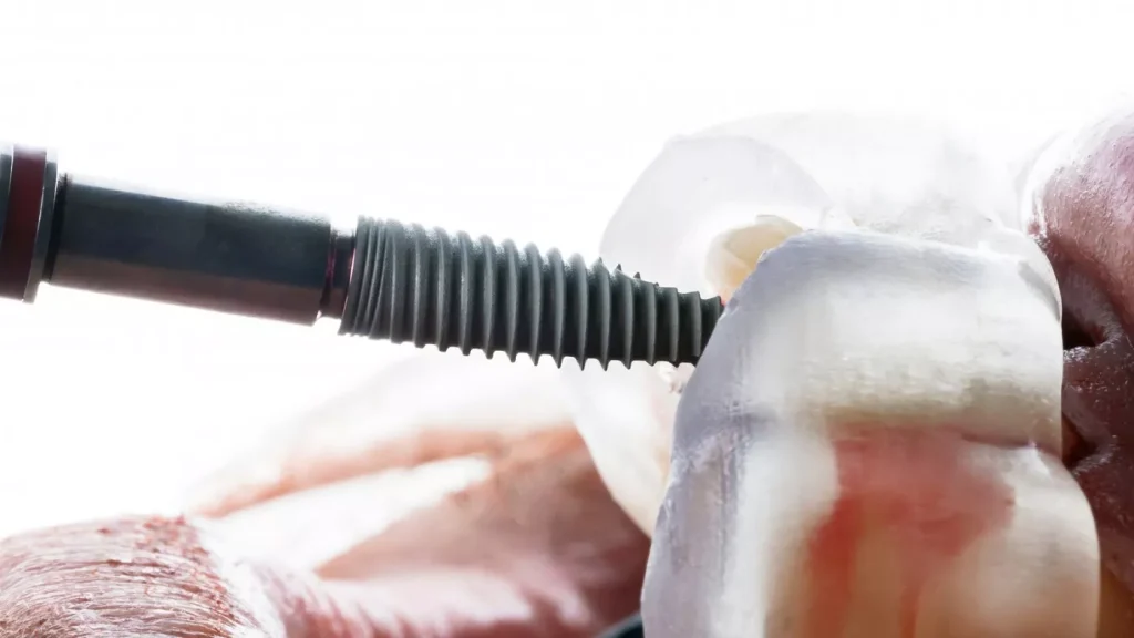 Implantul Dentar Doare1