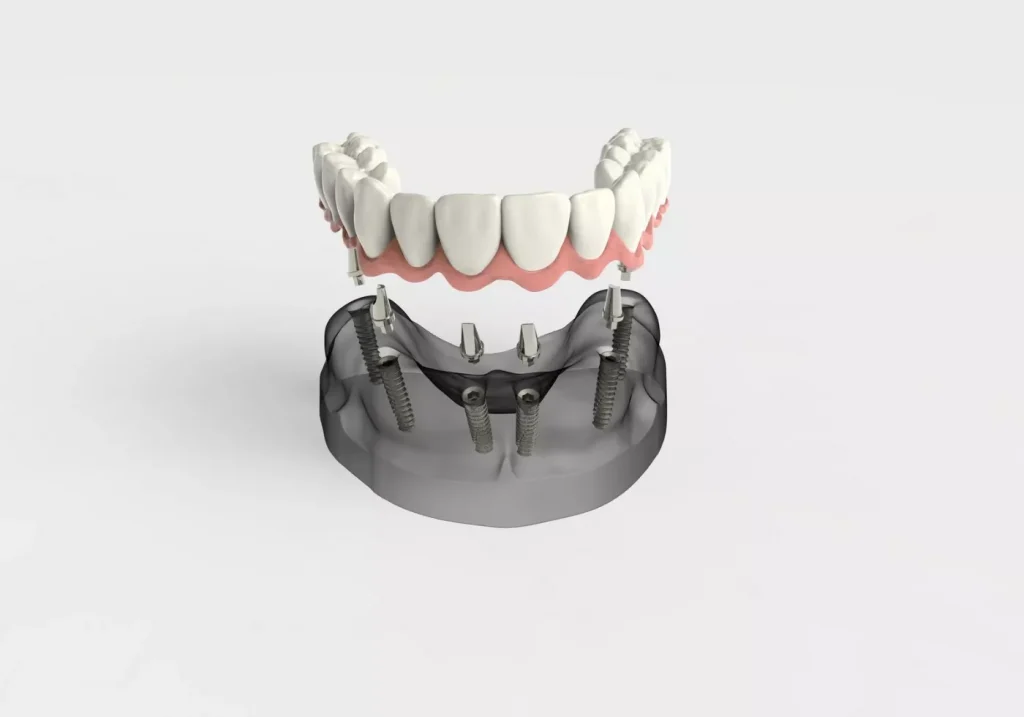 Implanturi Dentare – Avantaje și Dezavantaje1