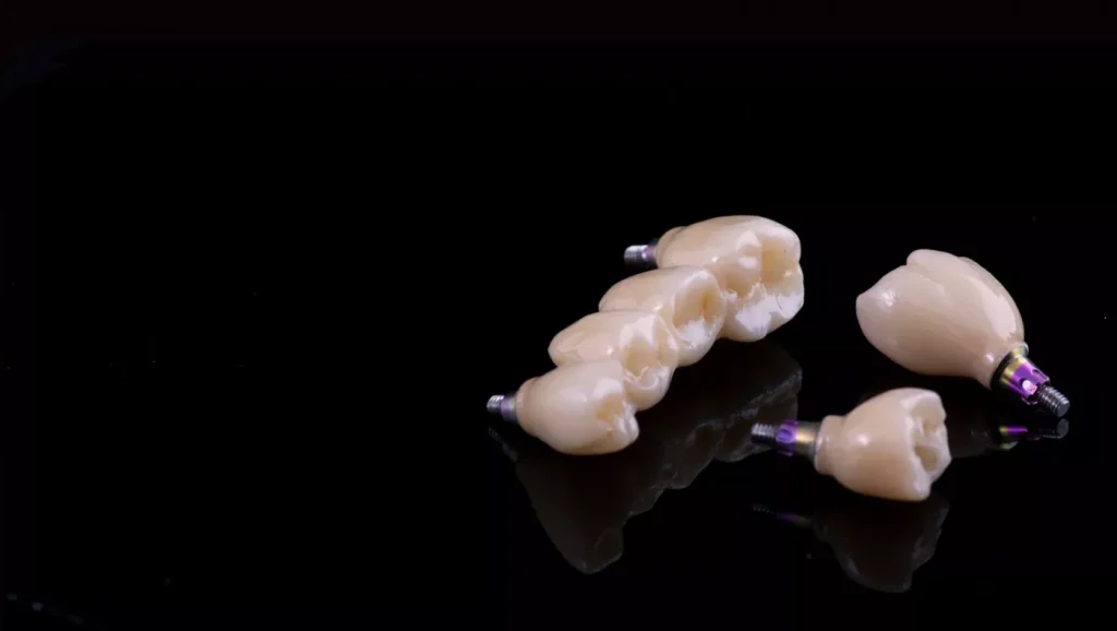 Implanturi Dentare – Avantaje și Dezavantaje2