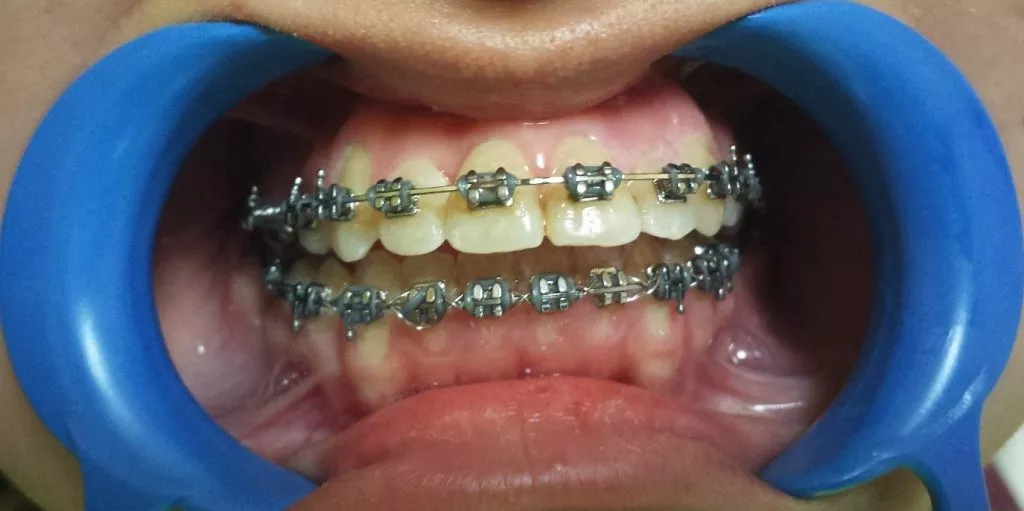 Ortodontia Dentara Clinica Stomatologica SteliDental Braila 1