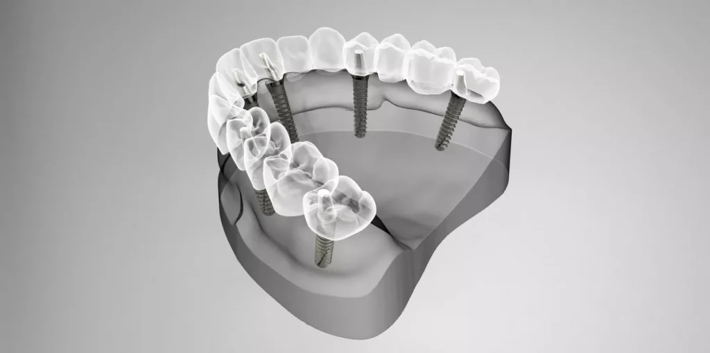 Pe Scurt, Despre Implantul Dentar2