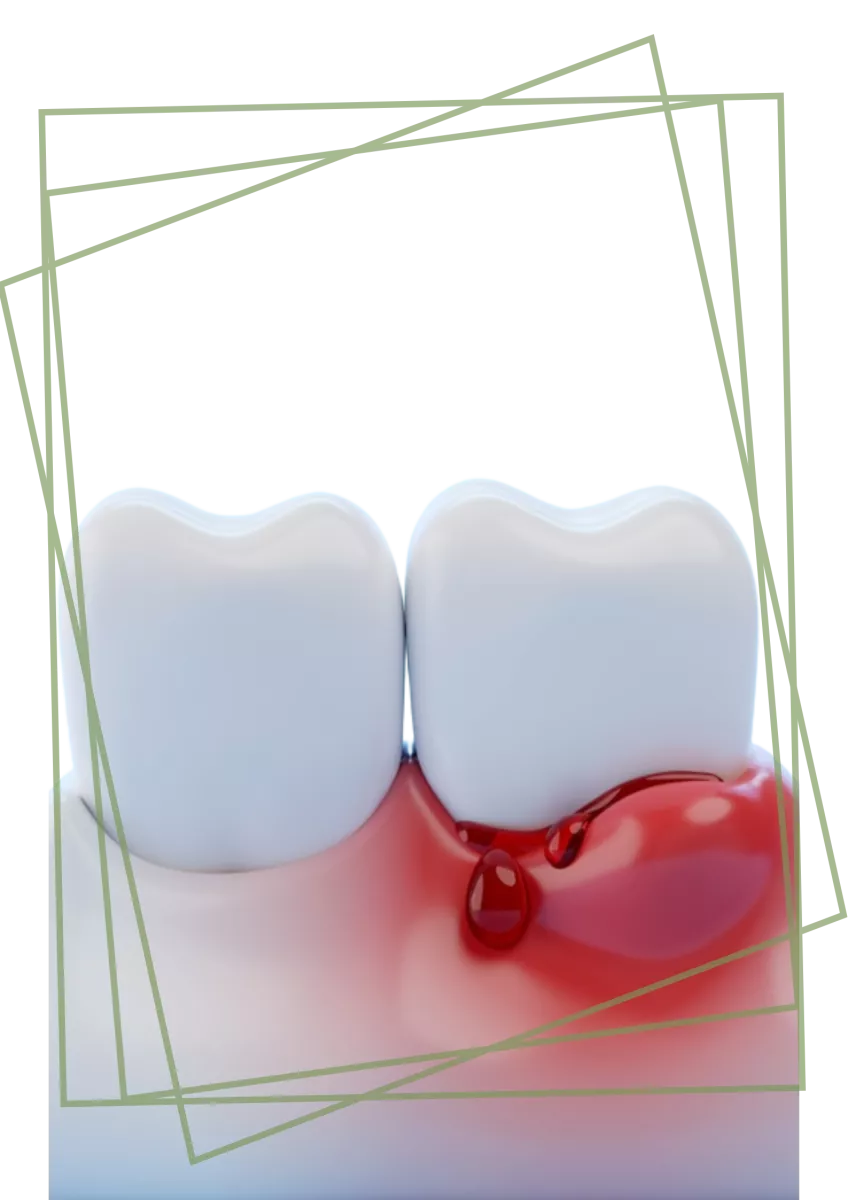 Tratament Parodontoza Dentara Clinica Stomatologica SteliDental Braila 6