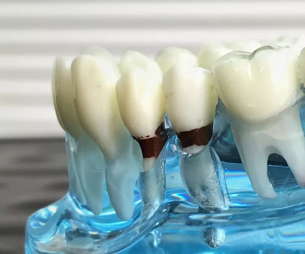 Articol Ce Este Parodontoza 2