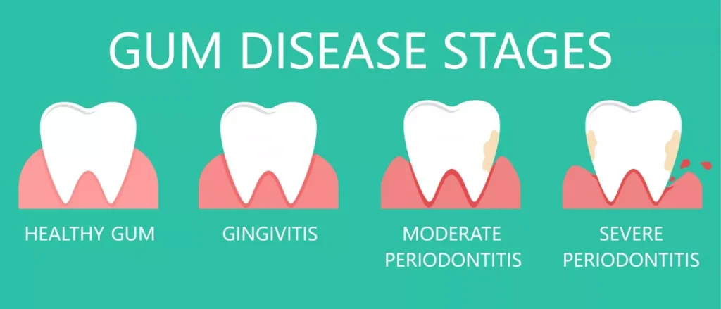 Articol Stadiile Bolii Parodontale 2