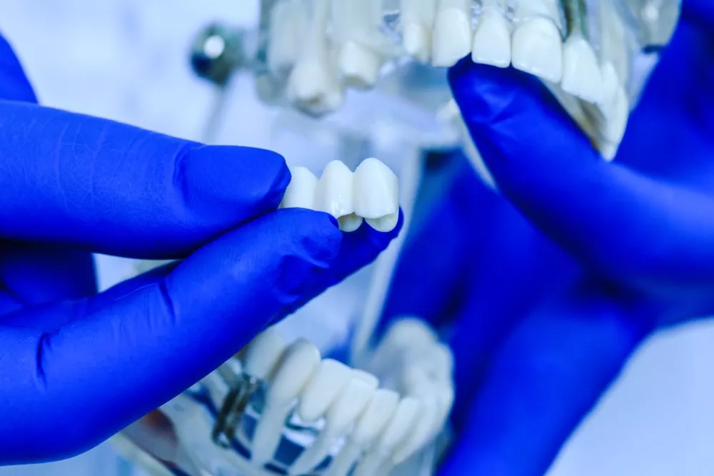 Puntile Dentare Braila Solutia Rapida Pentru Recapatarea Zambetului Complet