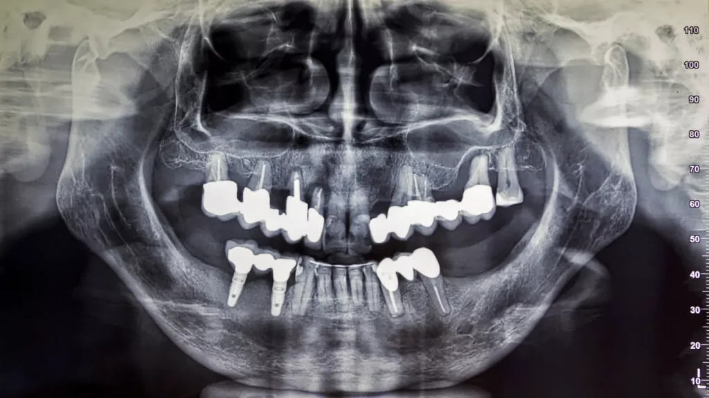 Radiologie Pe Intelesul Tau De Ce Ai Nevoie De Radiografii Dentare2 6925873c770a5