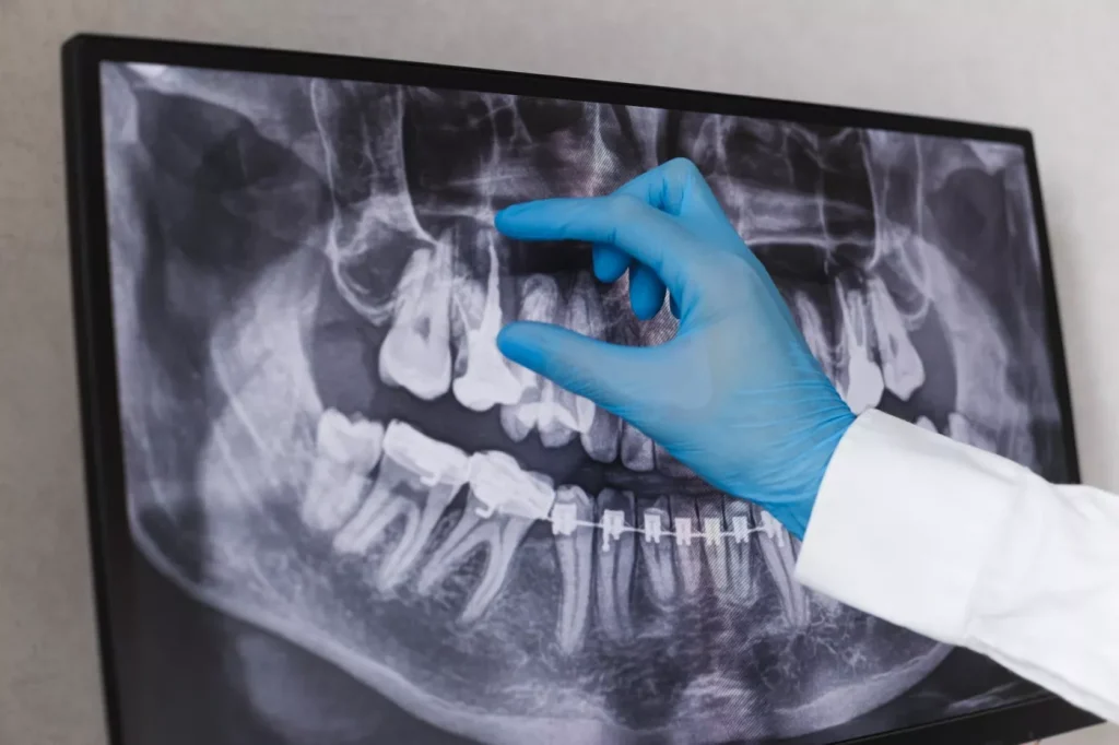 Radiologie Pe Intelesul Tau De Ce Ai Nevoie De Radiografii Dentare3 6925873c85b70