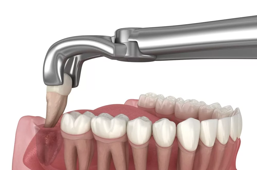 Ce Trebuie Sa Fac Dupa O Extractie Dentara Pentru O Vindecare Rapida1 69b11d760b154