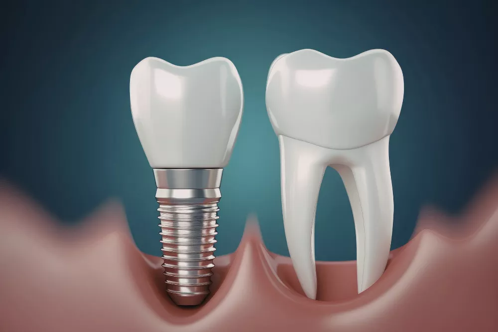 Implantologie In Braila Cand E Recomandat Un Implant Versus O Proteza 69b275263c06b