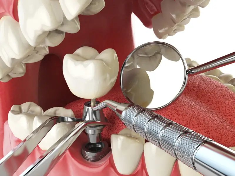 Implant Vs Proteza
